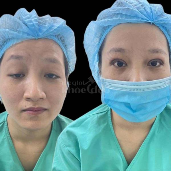 Cắt mí Plasma xoá bọng, da chùng, khâu giấu chỉ siêu mảnh – Cho đôi mắt tự nhiên, không lộ thẩm mỹ. - 4/4