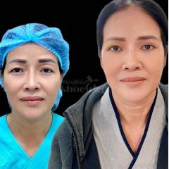 Nhấn mí Mini Deep – Công nghệ mới cho đôi mắt 2 mí đẹp chuẩn tự nhiên, không phẫu thuật, không để lạ