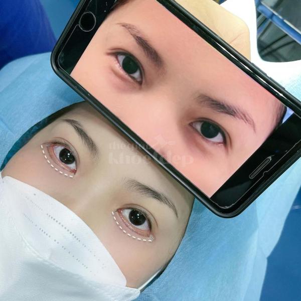 Cắt mí Hàn Quốc công nghệ mới – Khắc phục mắt 1 mí, sụp mí, da chùng, cho ánh nhìn rạng ngời tự nhiê - 4/4