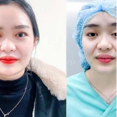 Combo Cắt mí + Nhấn mí Mini Deep – Trẻ hóa, xoá sụp mí, cho mắt 2 mí rõ tự nhiên và bền lâu.