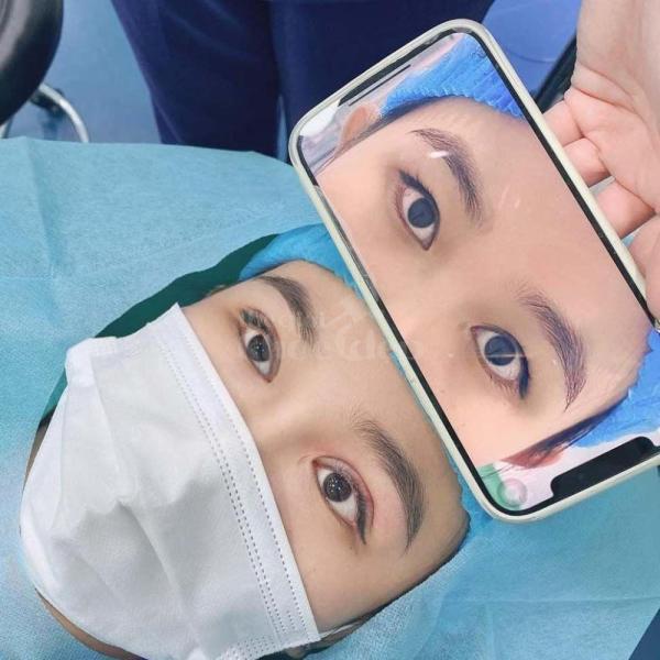 Combo Cắt mí + Nhấn mí Mini Deep – Trẻ hóa, xoá sụp mí, cho mắt 2 mí rõ tự nhiên và bền lâu. - 2/4