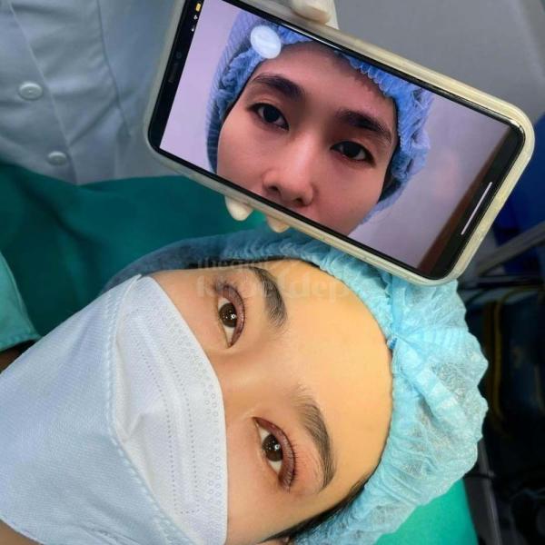 Cắt mắt 2 mí Mini Deep – Công nghệ tạo mí đẹp tự nhiên, an toàn - 3/4