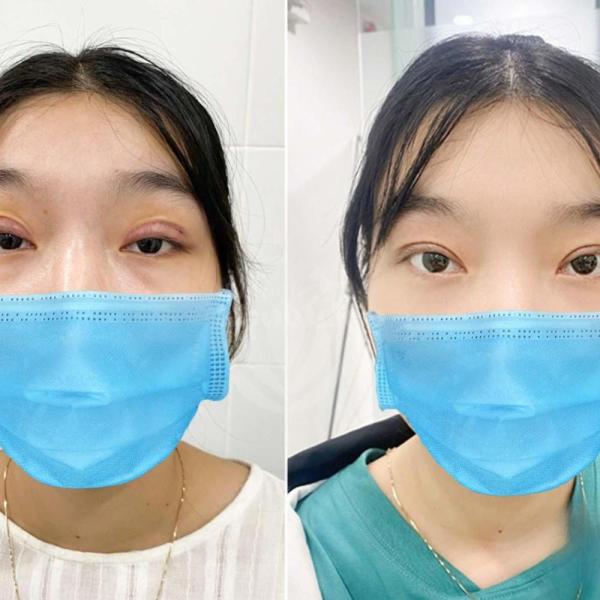 Cắt mí Plasma: Xóa bỏ da chùng, mở to đôi mắt, trẻ hóa toàn diện chỉ sau 1 lần thực hiện. - 1/4