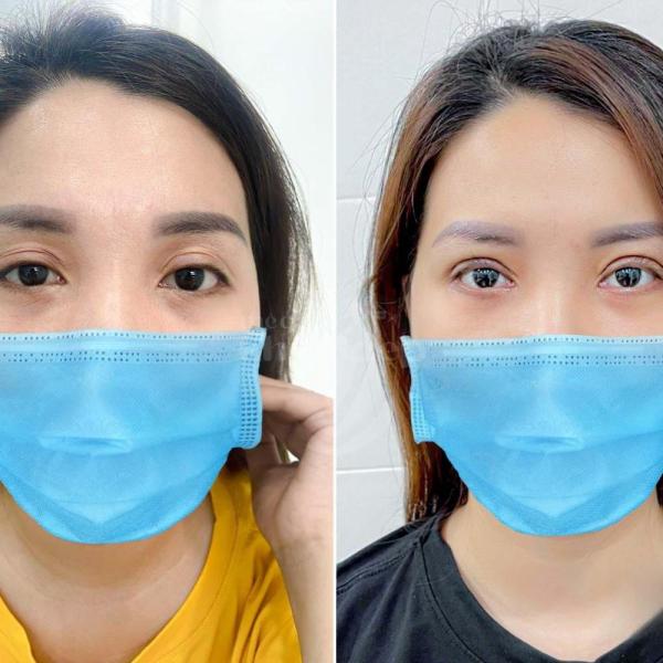 Cắt mí Plasma: Xóa bỏ da chùng, mở to đôi mắt, trẻ hóa toàn diện chỉ sau 1 lần thực hiện. - 2/4