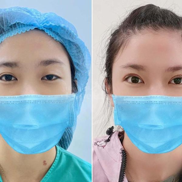 Cắt mí Plasma: Xóa bỏ da chùng, mở to đôi mắt, trẻ hóa toàn diện chỉ sau 1 lần thực hiện. - 3/4