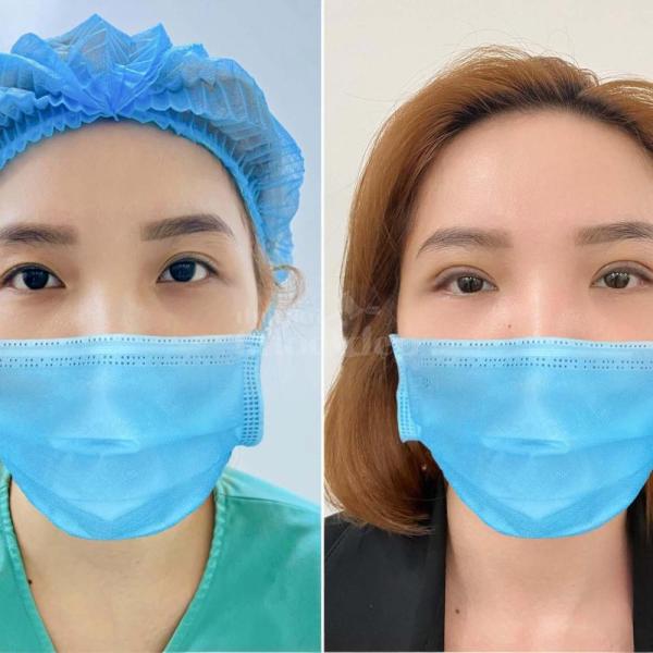 Cắt mí Mini Deep – Tạo đôi mắt hai mí sâu tự nhiên, đẹp bền lâu - 3/5