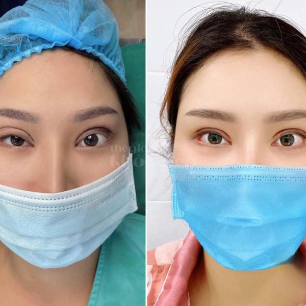 Cắt mí Mini Deep – Tạo đôi mắt hai mí sâu tự nhiên, đẹp bền lâu - 4/5