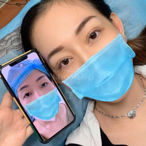 Cắt mí Mini Deep tạo nếp mí 2 mí rõ nét, tự nhiên và bền lâu - 1/4