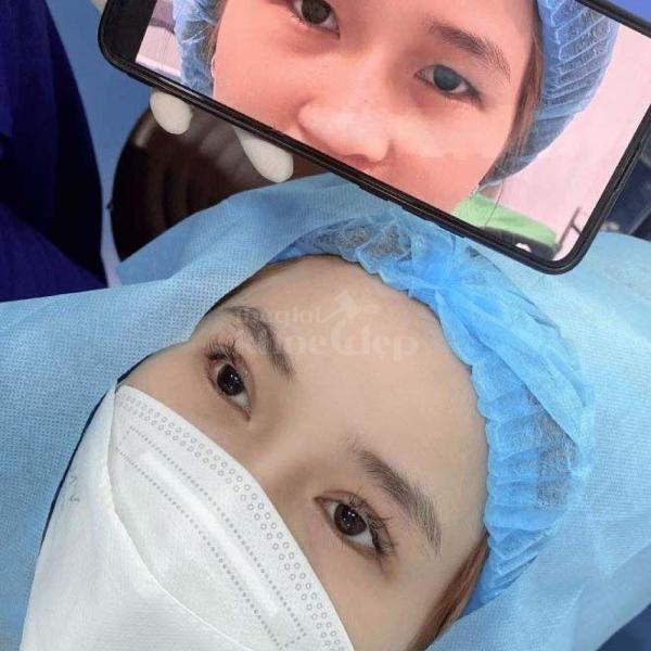 Cắt mí Mini Deep giải pháp tạo nếp mí 2 mí rõ nét, trẻ trung tự nhiên - 1/4