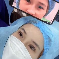 Cắt mí Mini Deep giải pháp tạo nếp mí 2 mí rõ nét, trẻ trung tự nhiên