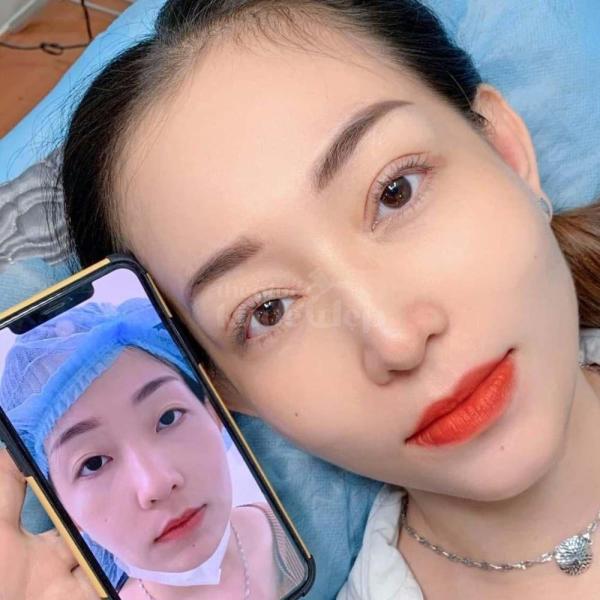 Cắt mí Mini Deep giải pháp tạo nếp mí 2 mí rõ nét, trẻ trung tự nhiên - 3/4