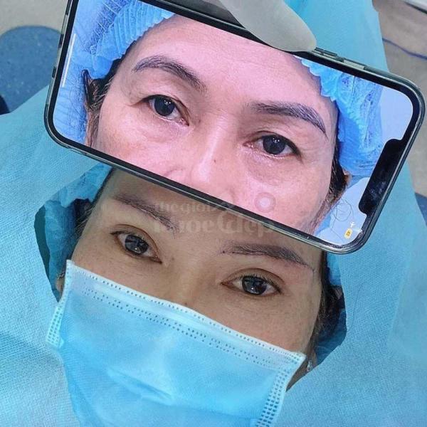 Cắt mí Mini Deep giải pháp tạo nếp mí 2 mí rõ nét, trẻ trung tự nhiên - 4/4