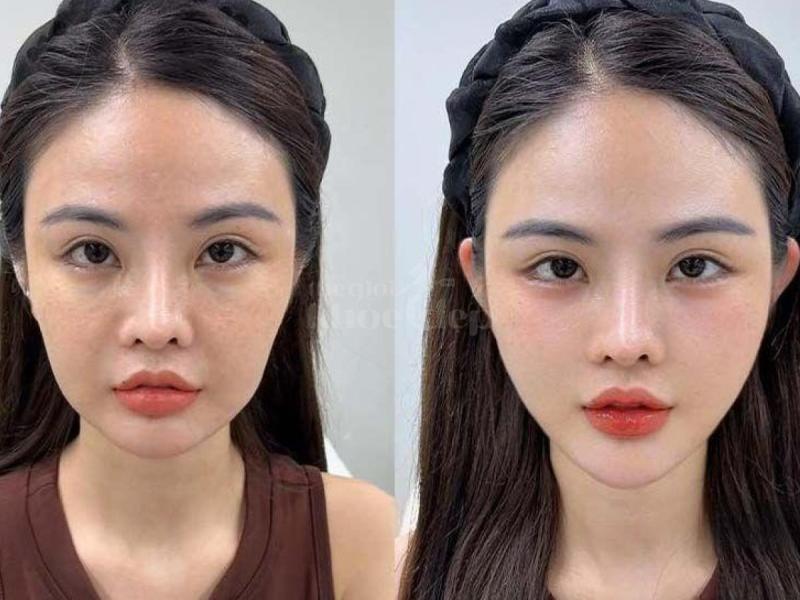 Tiêm má baby căng mịn, tự nhiên, trẻ trung – An toàn chuẩn bác sĩ - 1/4