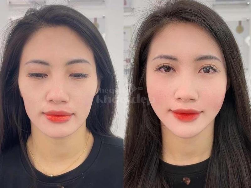 Tiêm má baby căng mịn, tự nhiên, trẻ trung – An toàn chuẩn bác sĩ - 3/4