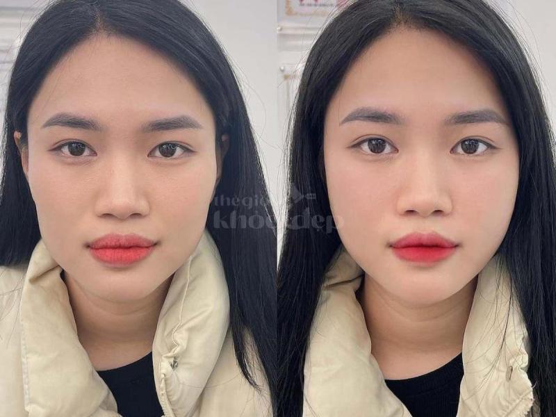 Tiêm má baby căng mịn, tự nhiên, trẻ trung – An toàn chuẩn bác sĩ - 4/4