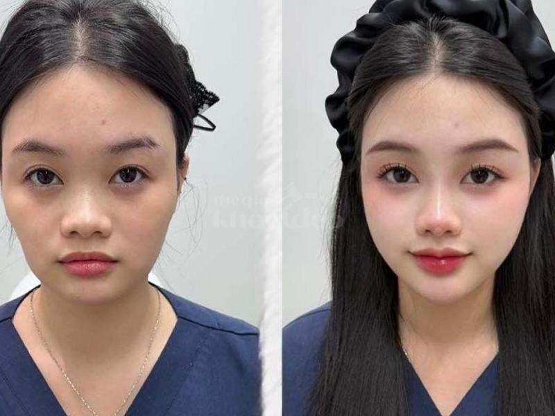 Tiêm má Baby – Giải pháp trẻ hóa gương mặt tự nhiên, bầu má căng đầy, duy trì lâu dài - 4/4