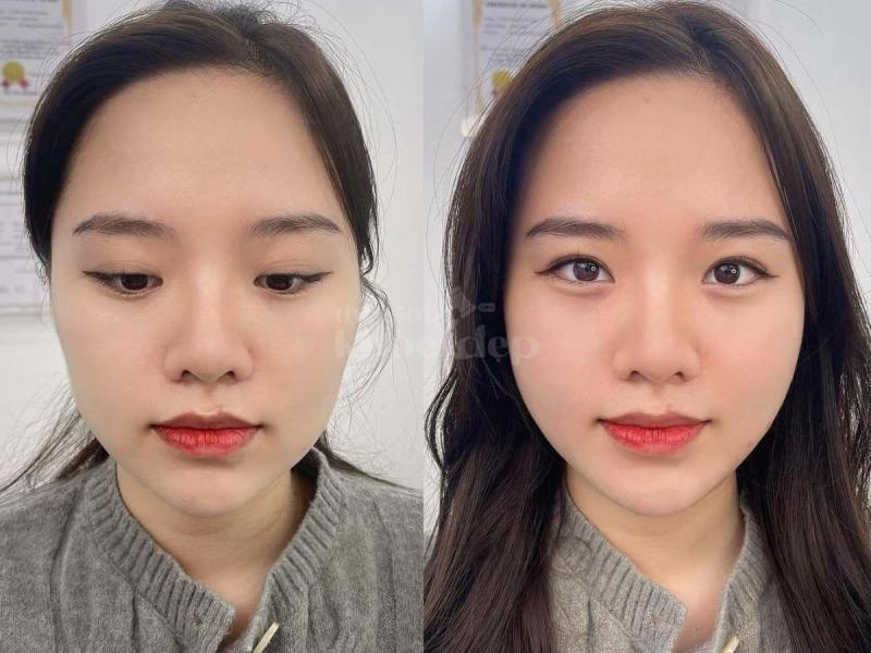 Tiêm Filler Thái Dương – Giải pháp khắc phục hõm thái dương, trẻ hóa gương mặt - 1/4