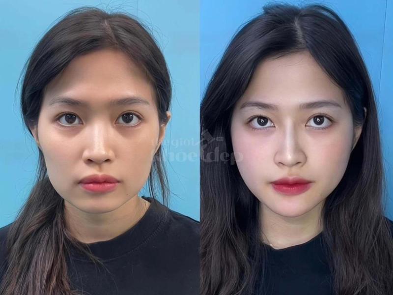 Tiêm Filler Thái Dương – Giải pháp khắc phục hõm thái dương, trẻ hóa gương mặt - 2/4