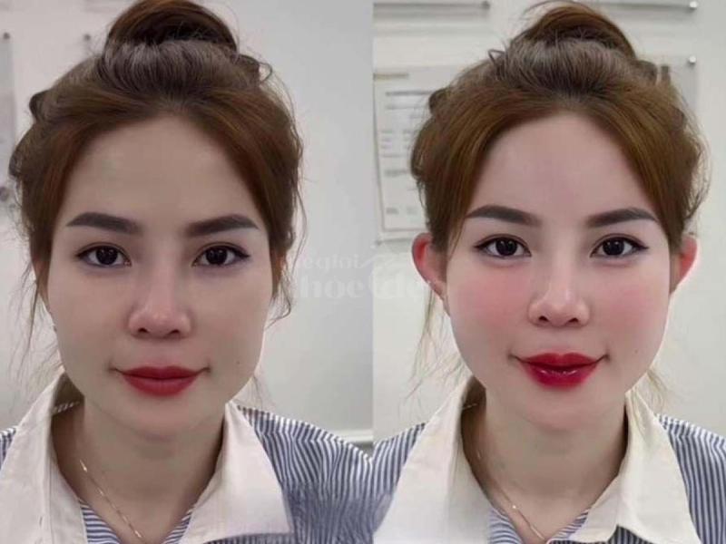 Tiêm Filler Thái Dương – Giải pháp khắc phục hõm thái dương, trẻ hóa gương mặt - 4/4