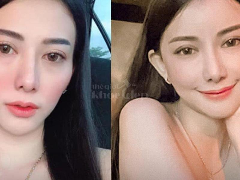 Tiêm má Baby – Giải pháp trẻ hóa gương mặt, khắc phục hóp má, mang lại nét đẹp căng đầy tự nhiên - 3/4