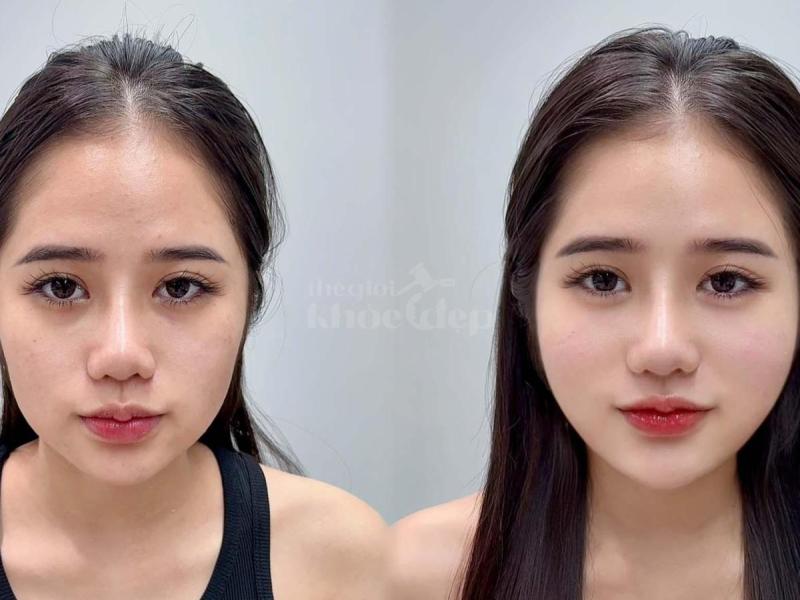 Tiêm má Baby cho nam & nữ U40–50: Giải pháp trẻ hóa, cân đối gương mặt - 1/4