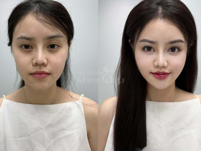 Tiêm má Baby cho nam & nữ U40–50: Giải pháp trẻ hóa, cân đối gương mặt - 2/4