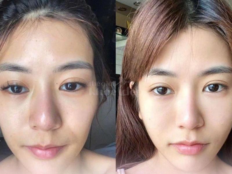 Tiêm má Baby cho nam & nữ U40–50: Giải pháp trẻ hóa, cân đối gương mặt - 4/4