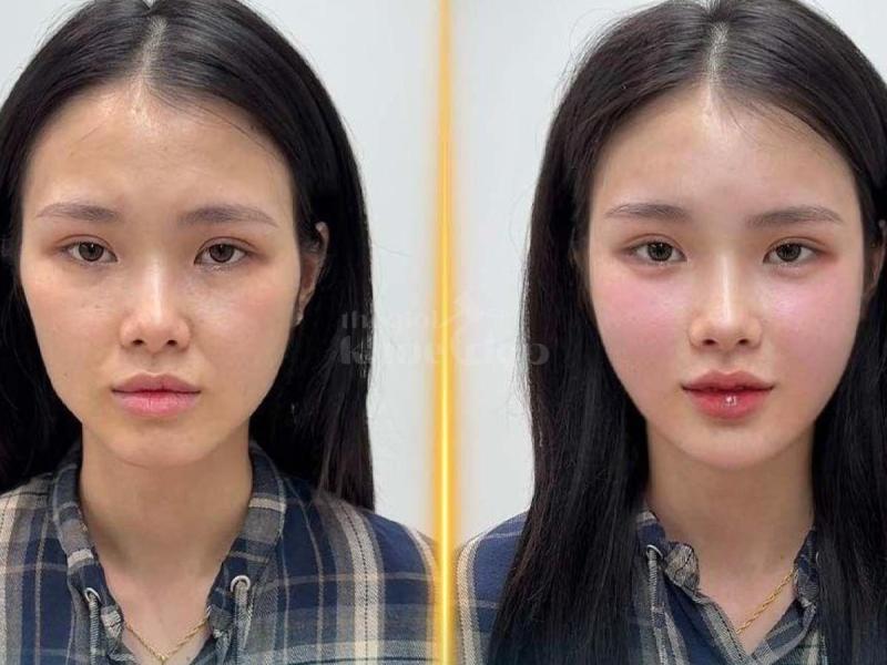 Tiêm má Baby trẻ hóa gương mặt – Xóa hõm má, giữ nét thanh xuân - 1/4