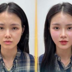 Tiêm má Baby trẻ hóa gương mặt – Xóa hõm má, giữ nét thanh xuân