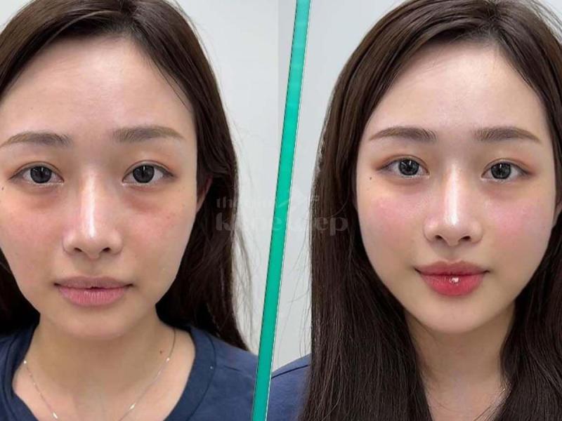 Tiêm má Baby trẻ hóa gương mặt – Xóa hõm má, giữ nét thanh xuân - 3/4