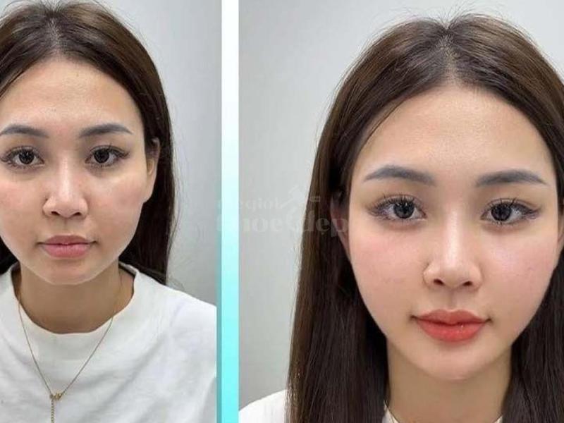 “Gò má cao, má hõm khiến bạn trông già hơn tuổi? – Tiêm má Baby trả lại gương mặt tươi trẻ, phúc hậu - 1/4