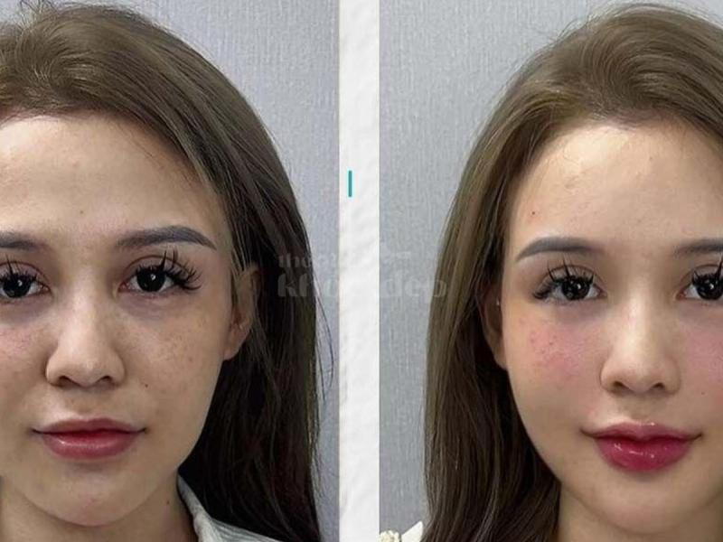 “Gò má cao, má hõm khiến bạn trông già hơn tuổi? – Tiêm má Baby trả lại gương mặt tươi trẻ, phúc hậu - 2/4