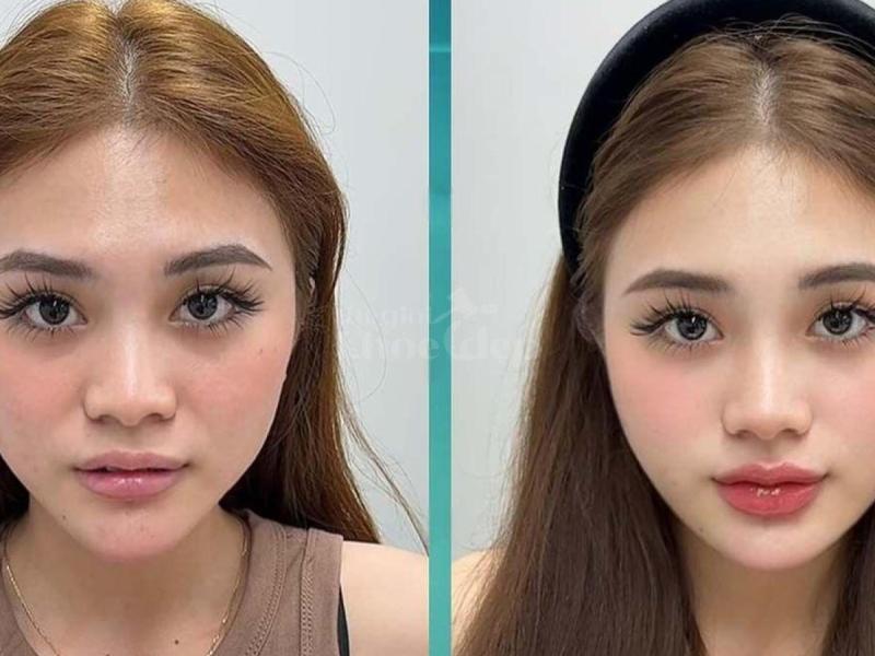 “Gò má cao, má hõm khiến bạn trông già hơn tuổi? – Tiêm má Baby trả lại gương mặt tươi trẻ, phúc hậu - 3/4