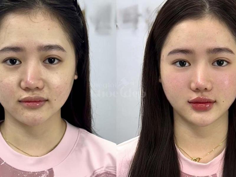 “Gò má cao, má hõm khiến bạn trông già hơn tuổi? – Tiêm má Baby trả lại gương mặt tươi trẻ, phúc hậu - 4/4