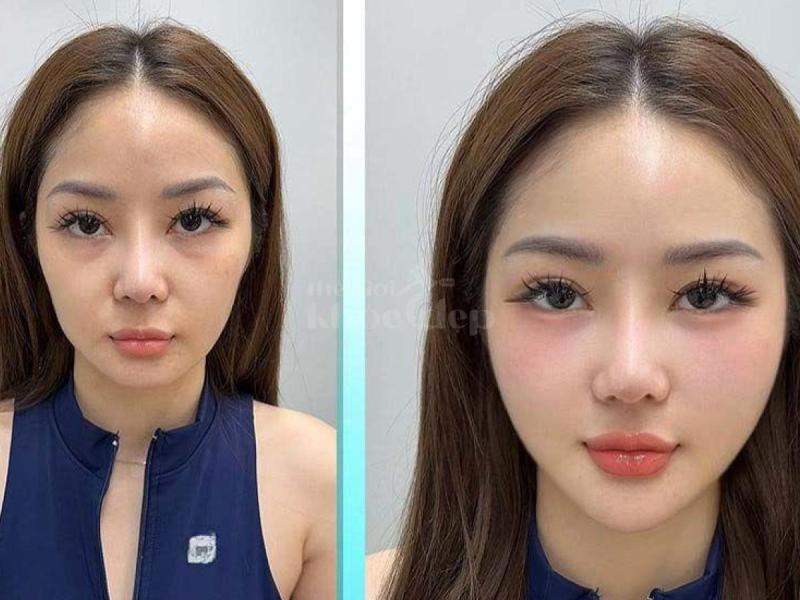 “Trẻ trung, phúc hậu chỉ sau 30 phút – Tiêm má Baby đang là bí quyết trẻ lâu mà phụ nữ hiện đại khôn - 2/4