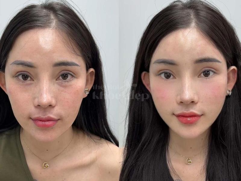 “Trẻ trung, phúc hậu chỉ sau 30 phút – Tiêm má Baby đang là bí quyết trẻ lâu mà phụ nữ hiện đại khôn - 3/4