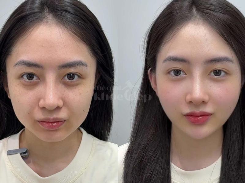 “Trẻ trung, phúc hậu chỉ sau 30 phút – Tiêm má Baby đang là bí quyết trẻ lâu mà phụ nữ hiện đại khôn - 4/4