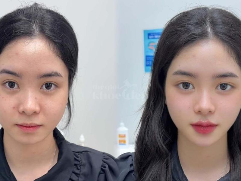 Tiêm má Baby – Lấy lại gương mặt đầy đặn, tươi trẻ cho phụ nữ văn phòng sau stress, mất ngủ kéo dài. - 1/4