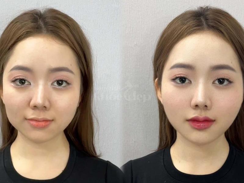 Tiêm má Baby – Lấy lại gương mặt đầy đặn, tươi trẻ cho phụ nữ văn phòng sau stress, mất ngủ kéo dài. - 2/4