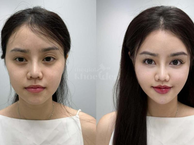 Phụ nữ sau sinh hóp má, gương mặt già trước tuổi – Tiêm má Baby mang lại sự tươi trẻ, rạng rỡ. - 1/4