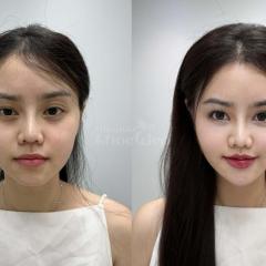 Phụ nữ sau sinh hóp má, gương mặt già trước tuổi – Tiêm má Baby mang lại sự tươi trẻ, rạng rỡ.