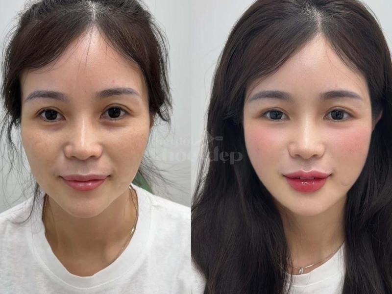 Phụ nữ sau sinh hóp má, gương mặt già trước tuổi – Tiêm má Baby mang lại sự tươi trẻ, rạng rỡ. - 4/4