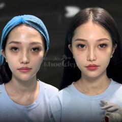 Dân văn phòng ngồi nhiều, stress, da chảy xệ – Tiêm má Baby giúp gương mặt trẻ trung, cân đối chỉ sa