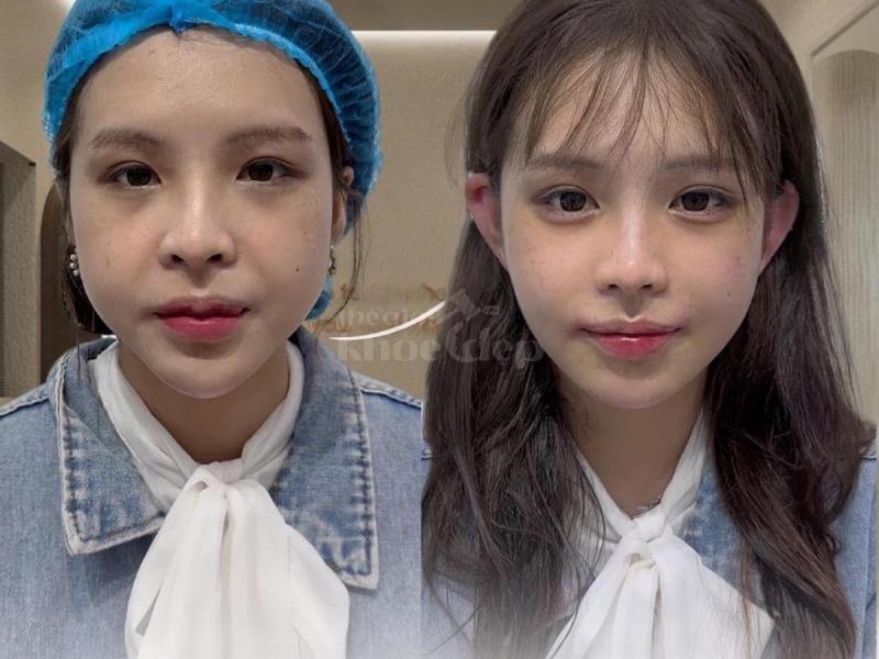 Dân văn phòng ngồi nhiều, stress, da chảy xệ – Tiêm má Baby giúp gương mặt trẻ trung, cân đối chỉ sa - 2/4