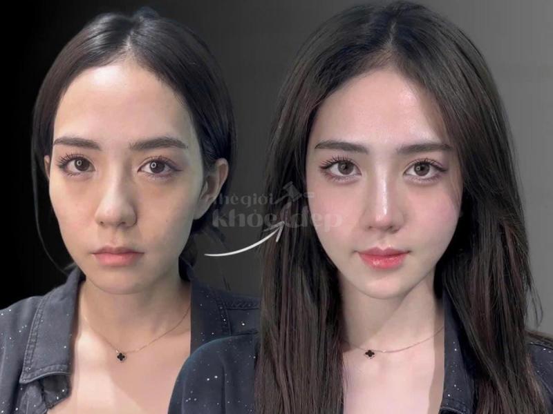 Dân văn phòng ngồi nhiều, stress, da chảy xệ – Tiêm má Baby giúp gương mặt trẻ trung, cân đối chỉ sa - 4/4