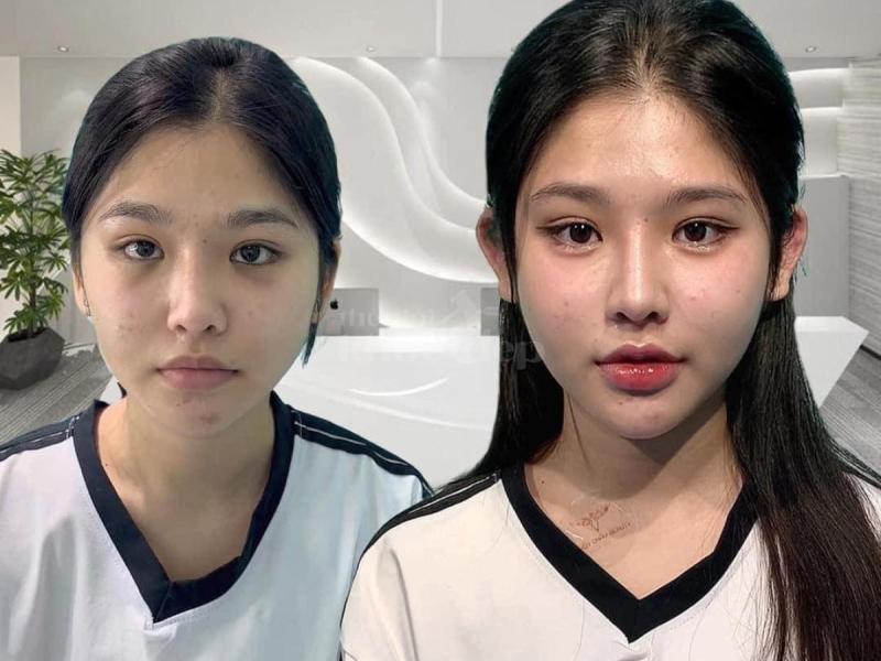 Khách hàng U40–U60 muốn gương mặt đầy đặn, phúc hậu – Tiêm má Baby giúp trẻ ra 5–10 tuổi an toàn, tự - 1/4