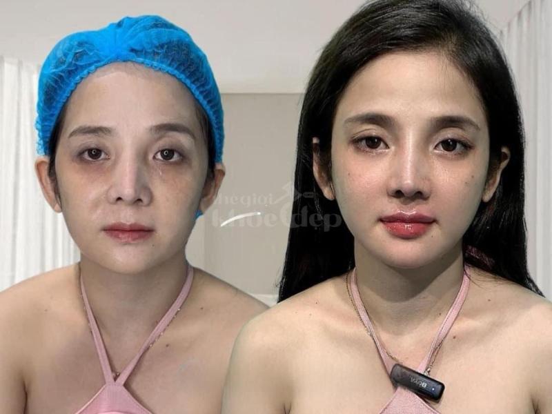 Khách hàng U40–U60 muốn gương mặt đầy đặn, phúc hậu – Tiêm má Baby giúp trẻ ra 5–10 tuổi an toàn, tự - 4/4