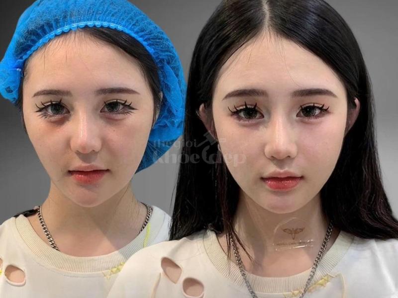 Tiêm má Baby giúp gương mặt V-line nhưng không hóp, vẫn trẻ trung, hài hòa, duyên dáng - 1/4