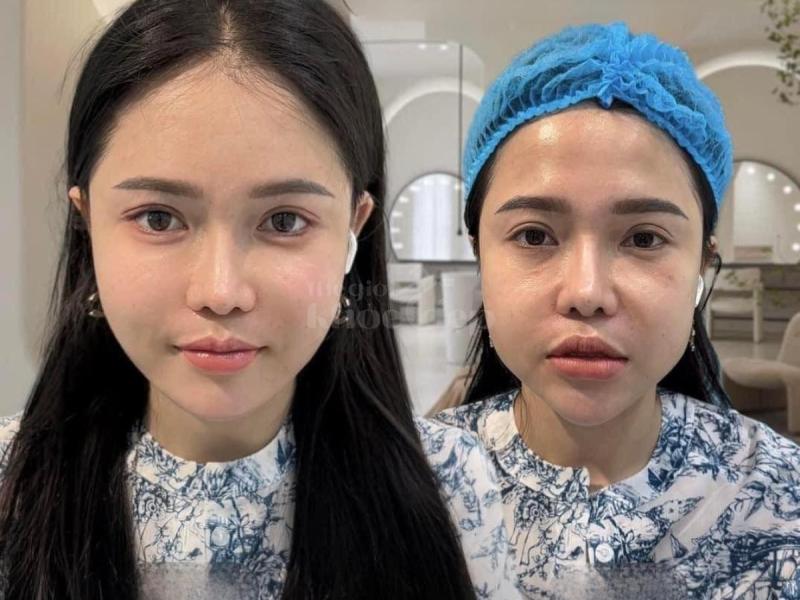 Tiêm má Baby giúp gương mặt V-line nhưng không hóp, vẫn trẻ trung, hài hòa, duyên dáng - 2/4