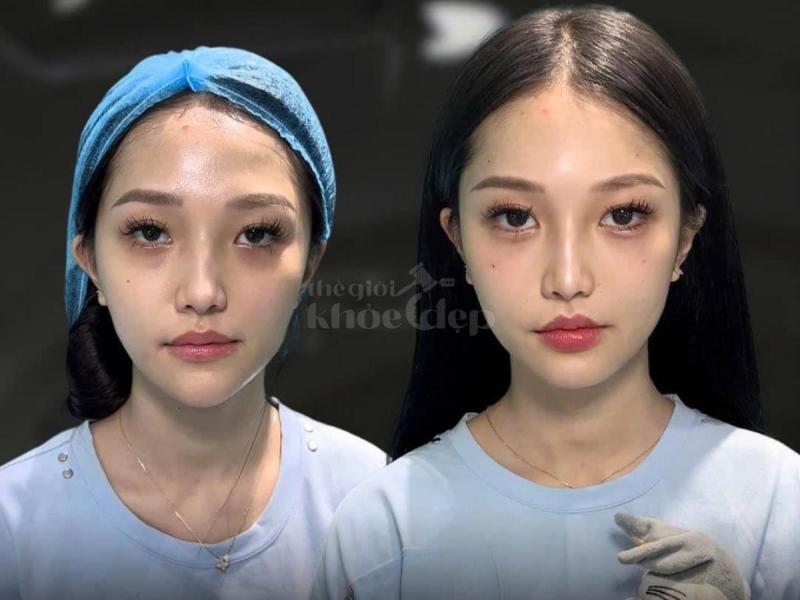 Tiêm má Baby giúp gương mặt V-line nhưng không hóp, vẫn trẻ trung, hài hòa, duyên dáng - 4/4